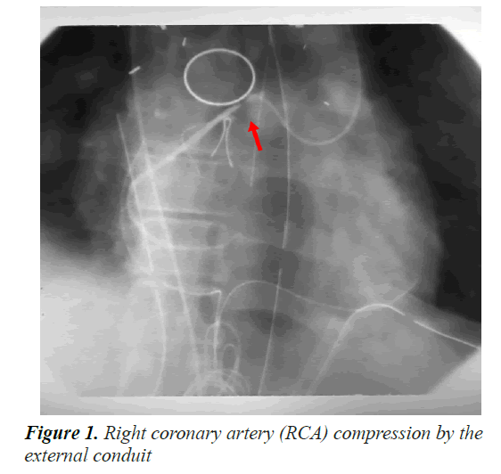 Coronary Compression by a Right Ventricle to Pulmonary Artery Conduit