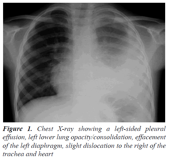 Atypical Kawasaki Disease Presenting As Refractory Pneumonia Atypical Kawasaki Disease Presenting As Refractory Pneumonia